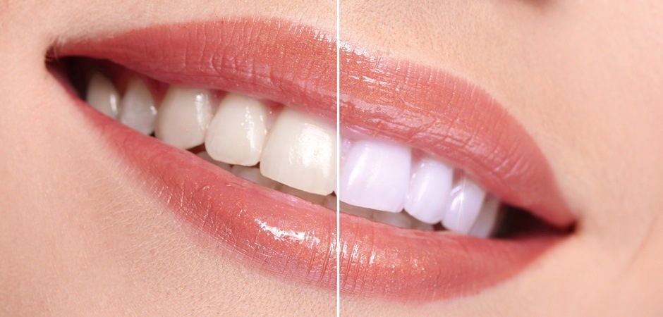 Отбеливающие пасты: белоснежная улыбка без вреда для зубов? Памятка от стоматолога рис-2